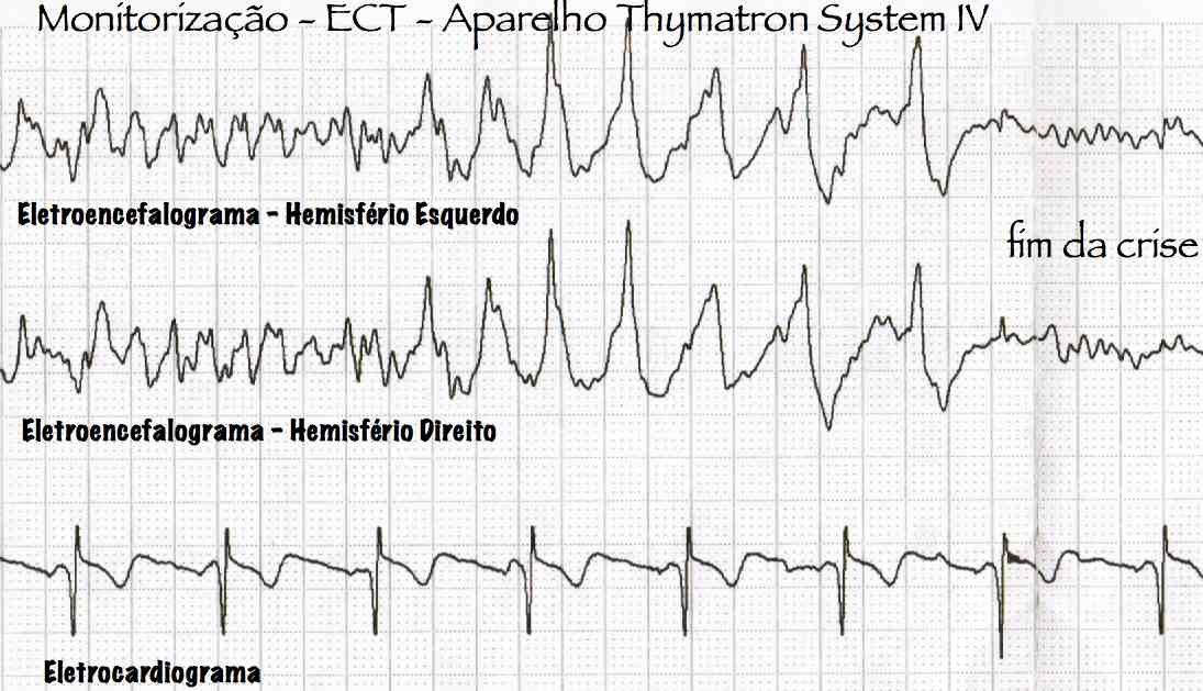 EEG Thymatron